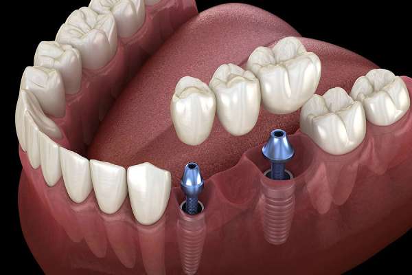 Dental Implant​