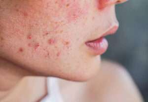 Safety Precautions For Acne