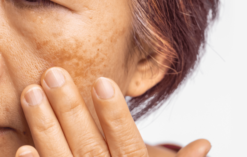 Understanding Melasma