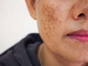 Managing Hyperpigmentation