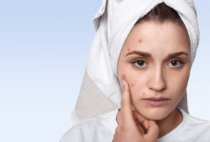 Effective Treatments for Acne Scarring at Cosmothetics