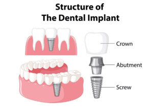 Dental Implants: The Ultimate Solution for Missing Teeth