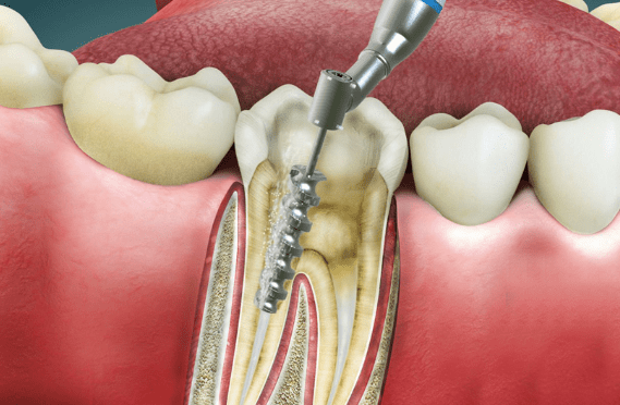 Understanding Root Canal Treatment