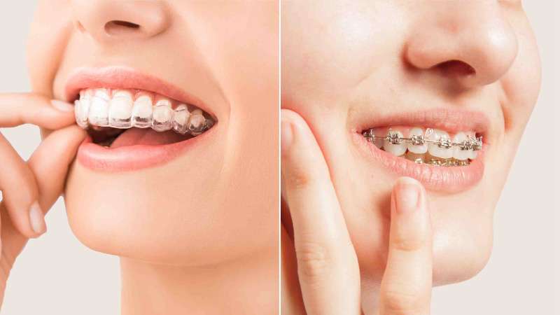 Dental Braces and Aligners