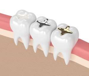 Know About Dental Fillings