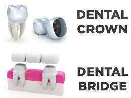 The Importance of Dental Crowns and Bridges