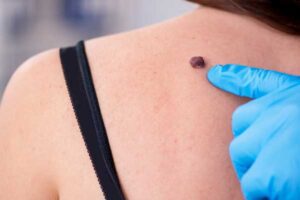 Understanding Mole, Tag, and Tattoo Removal