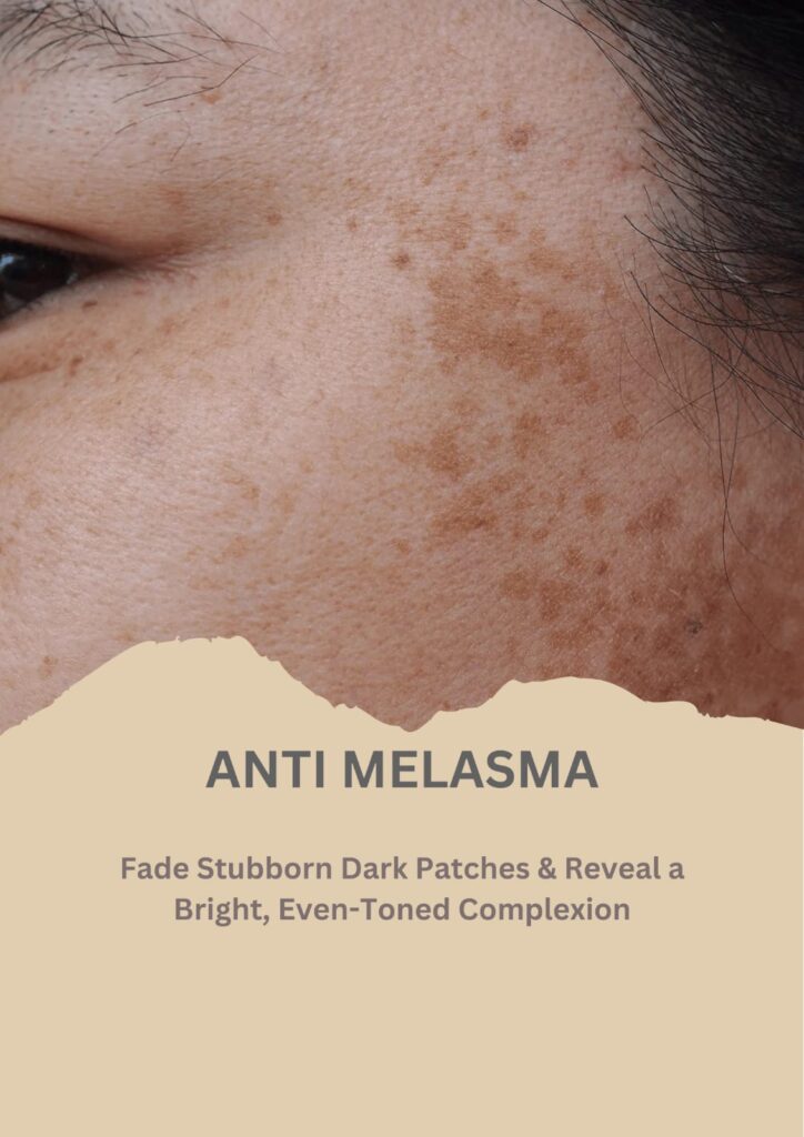melasma
