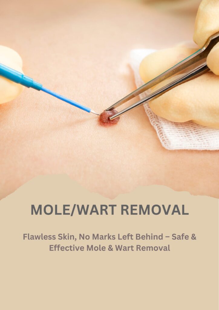 Mole Removal