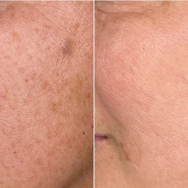 Skin Rejuvenation Treatments in Lahore – Get Consultation