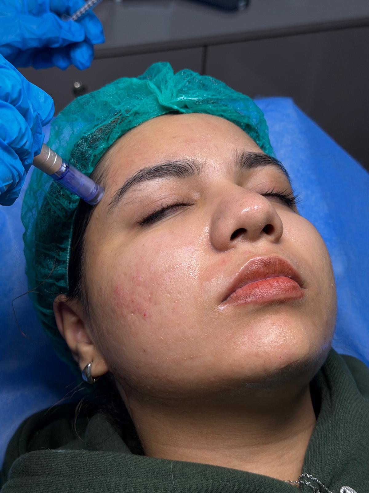 co2 laser treatment lahore