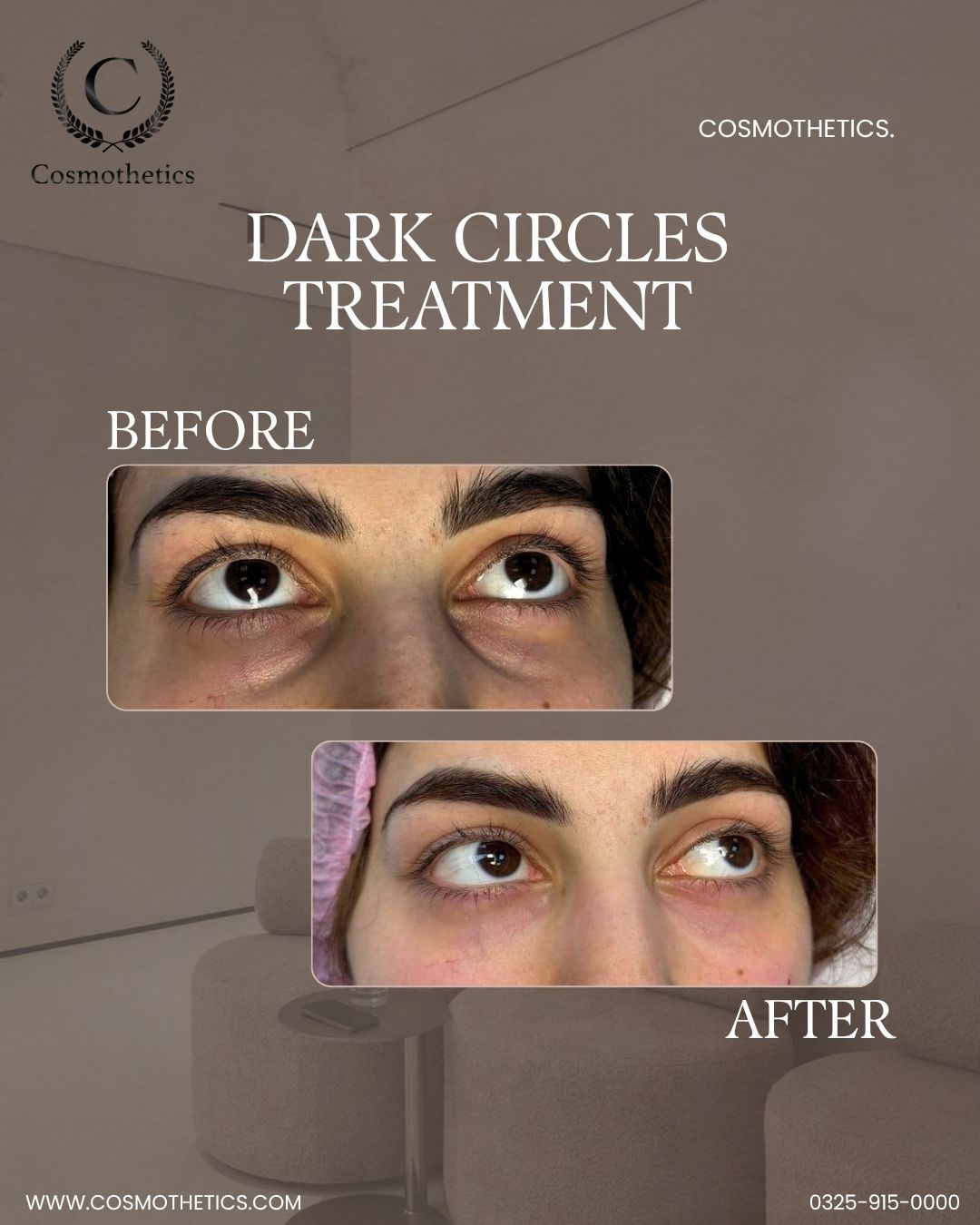 dark circles treatment clinic in lahore