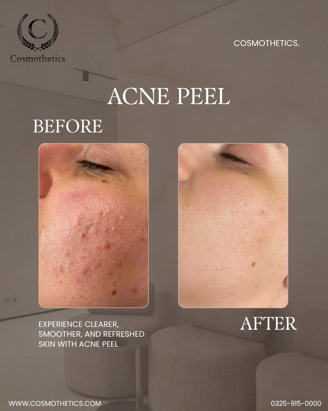 chemical peel treatment clinic in lahore