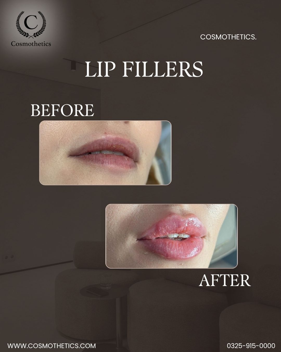 lip fillers treatment clinic in lahore